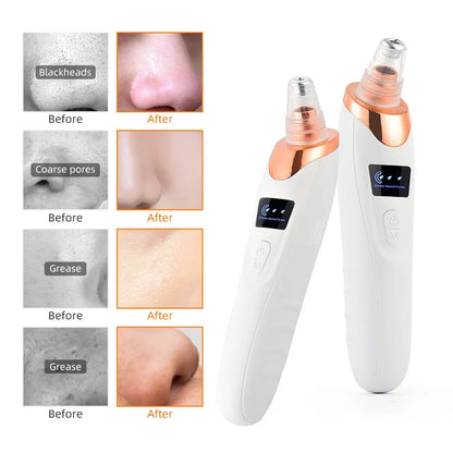 Vacuum Blackhead & Pimple Remover